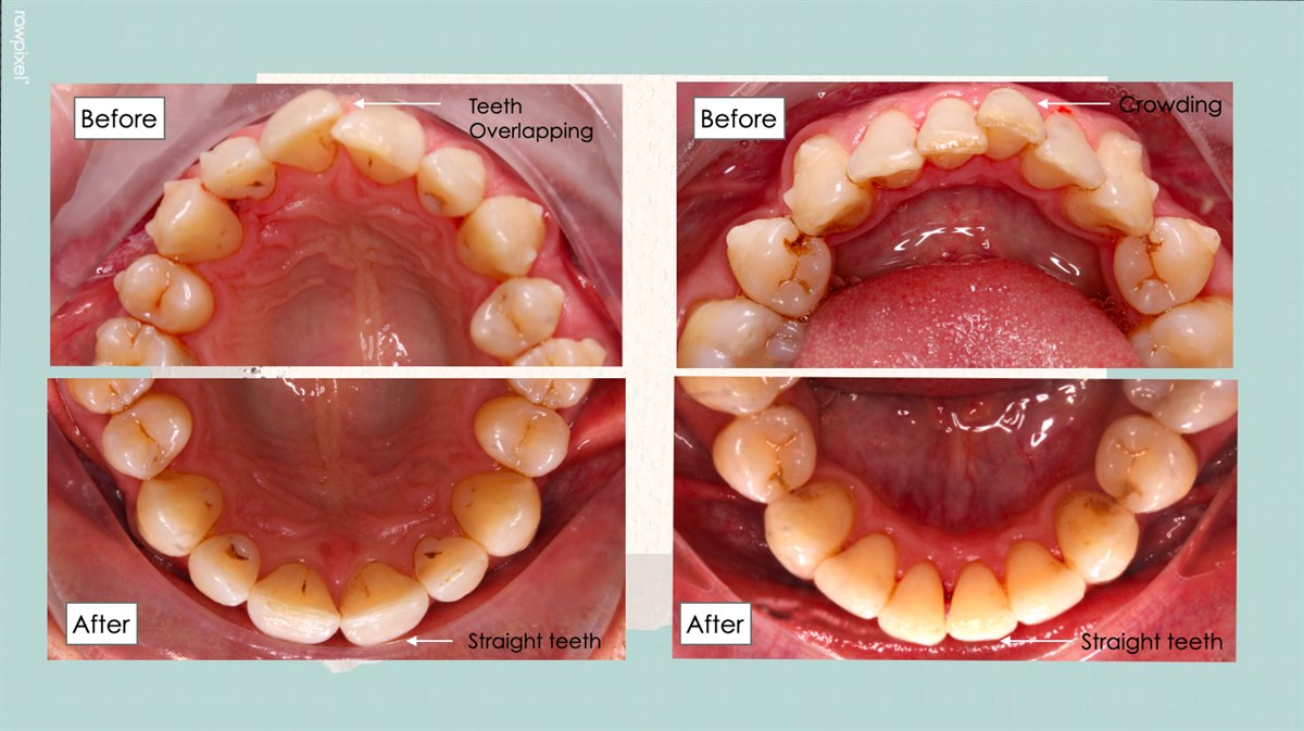 Voor en na Invisalign aligners - rechte tanden traject