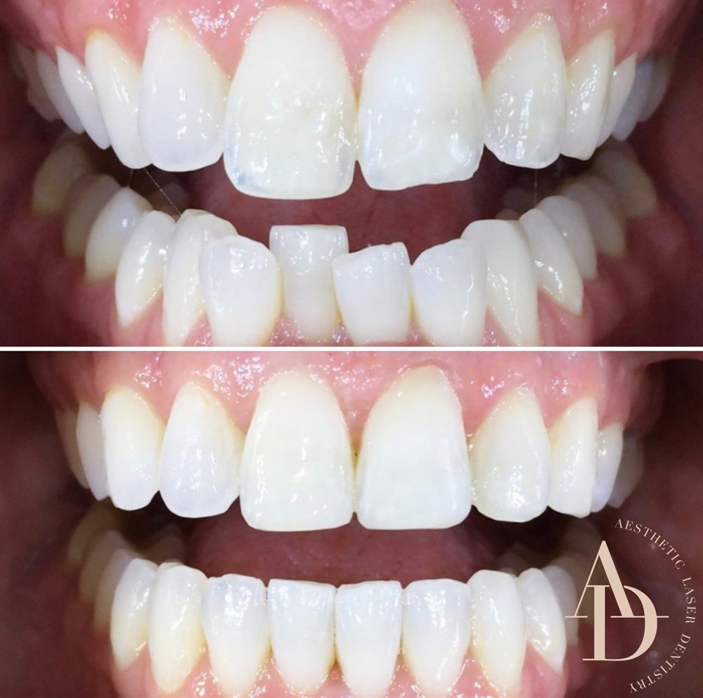 Voor en na Invisalign aligners - rechte glimlach na traject
